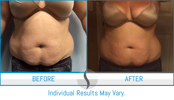 CoolSculpting® in Orlando, FL