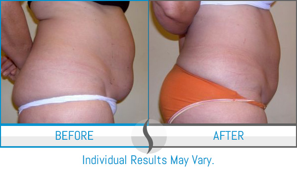 Body Contouring Near Me in Southampton, PA, and Langhorne, PA