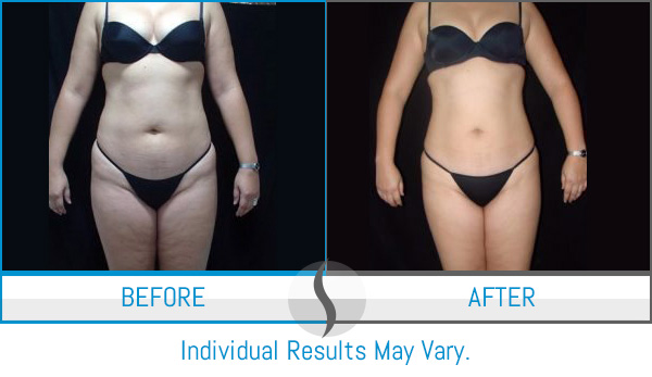 Body Contouring Specialist Near Me in Chesapeake, VA