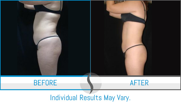 Body Contouring in Kissimmee & Melbourne FL - First Health