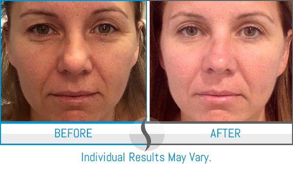 Before & After - Spa Blue Skin Care & Laser Center Orlando, FL