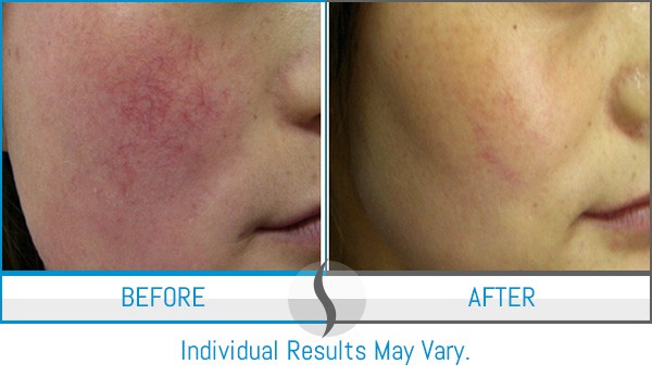 Before & After - Spa Blue Skin Care & Laser Center Orlando, FL