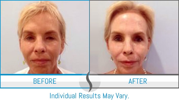 Before & After - Spa Blue Skin Care & Laser Center Orlando, FL