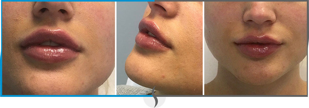 Lip Fillers - Spa Blue Skin Care & Laser Center in Orlando, FL